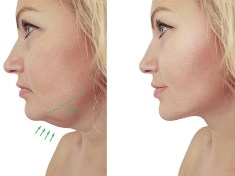 نحوه انجام ساکشن غبغب به چه صورت است