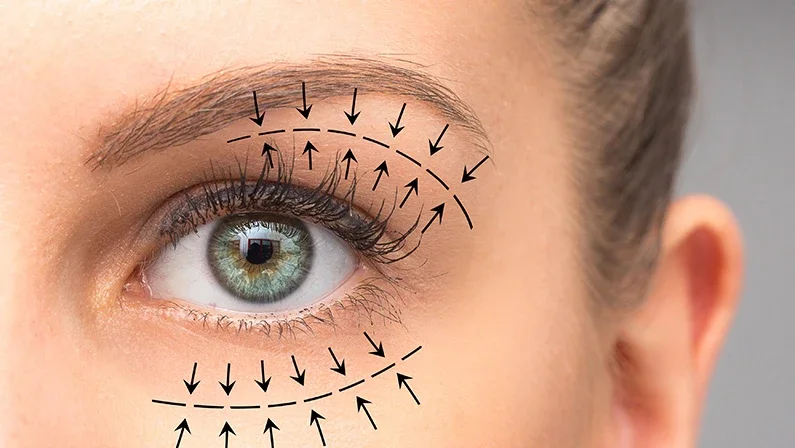 بلفاروپلاستی چهار پلک چیست