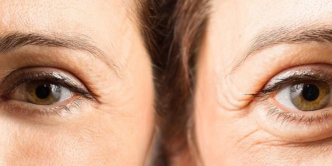 بهترین کلینیک بلفاروپلاستی در یزد