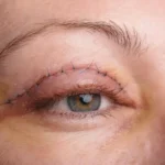 سوالات متداول در مورد بلفاروپلاستی