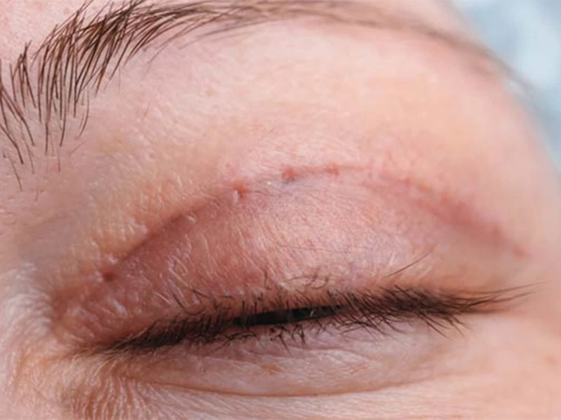 سوالات متداول در مورد بلفاروپلاستی