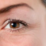 دوره نقاهت بلفاروپلاستی چقدر است؟ مراقبت های پس از آن