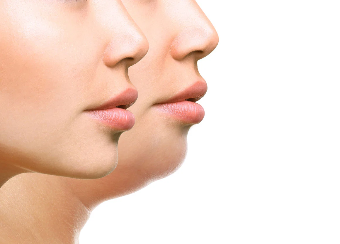 مزایای انجام ساکشن غبغب در کلینیک هیوا