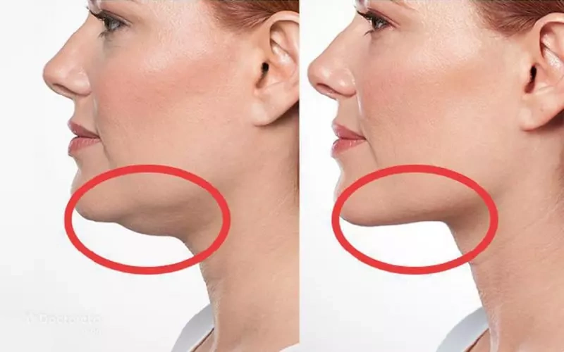 مقایسه ساکشن غبغب با دستگاه لاغری غبغب