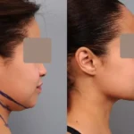 مقایسه ساکشن غبغب با دستگاه لاغری غبغب