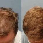 جدیدترین روش کاشت مو طبیعی