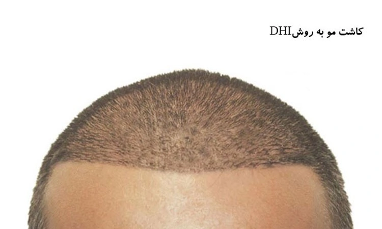 جدیدترین روش کاشت مو طبیعی