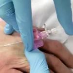 ورود حباب هوا از طریق سرم به رگ