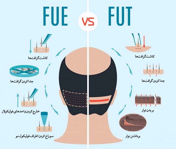 کاشت مو fit یا fut