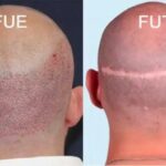 مقایسه و بررسی روش های کاشت مو fit یا fut