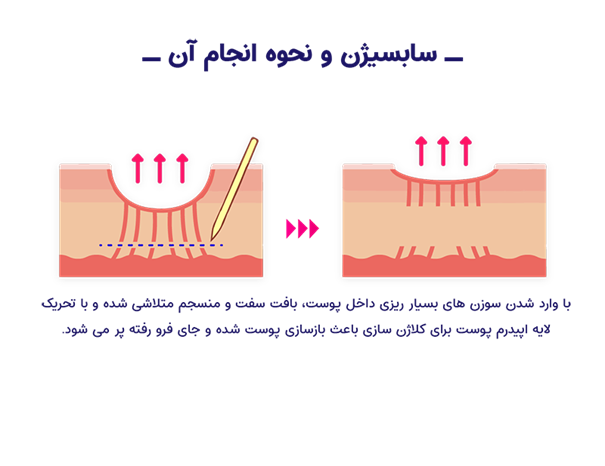 ساب سیژن