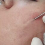 سابسیژن ، درمان جای جوش