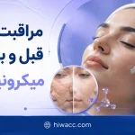 مراقبت‌های قبل و بعد از میکرونیدلینگ + راهنمای کامل برای نتیجه بهتر و پوست سالم‌تر