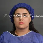 ساکشن غب غب