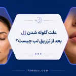 علت گلوله شدن ژل بعد از تزریق لب چیست؟ + راه‌های پیشگیری و درمان