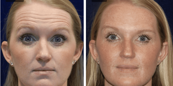 بوتاکس ( Botox ) 1 Botox_01