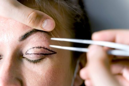 Eye-Lid_Surgery-min بلفاروپلاستی